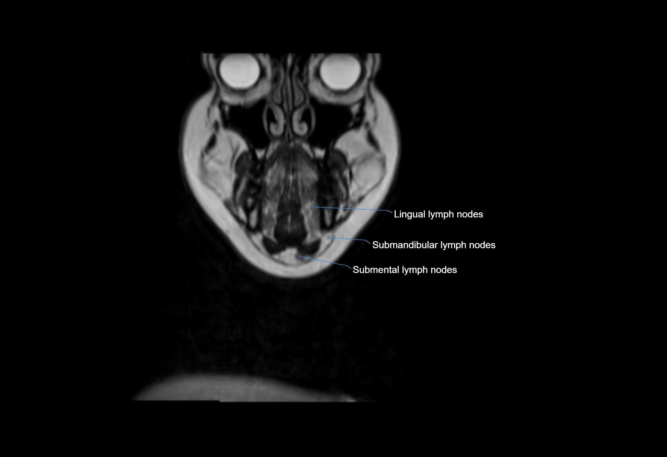 Neck coronal lymph node cross sectional MRI anatomy 3T MRI  image-img-00001-00065.webp